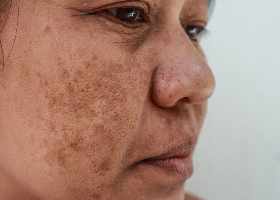 Pigmentation & Skin Concerns